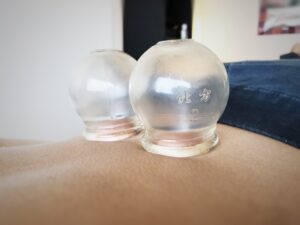 Cupping, Acupuncture, Chinese Medicine, Bodywork, Natural Healing